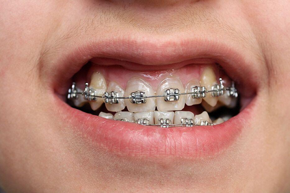 Eligibility Criteria for Free Braces Under Texas Medicaid