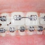 Does Medicaid Cover Braces