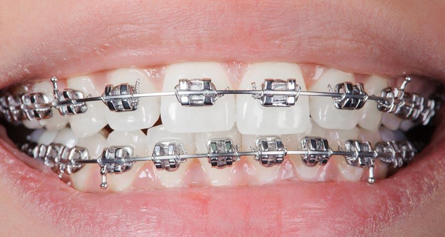 Navigating the⁣ Application Process for Braces Under Medicaid